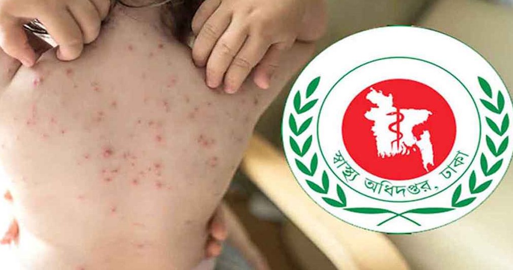 হামের উপসর্গে আরও ৩ শিশুর মৃত্যু